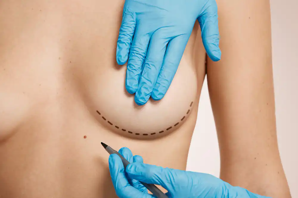 Breast augmentation implants in Playa del Carmen for cosmetic breast surgery