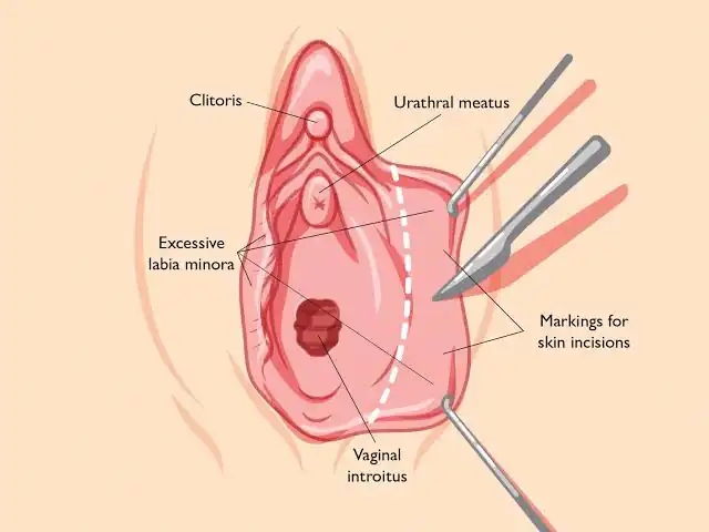 Labiaplasty procedure information in Playa del Carmen